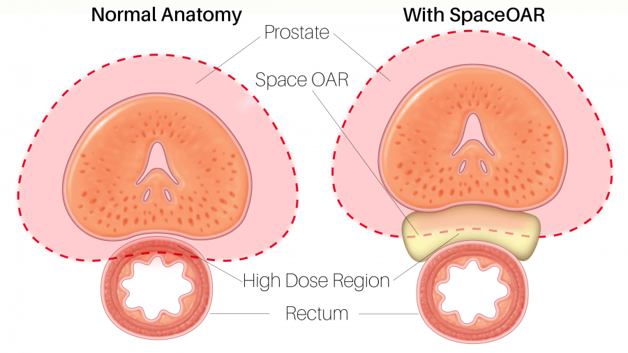 Prostate Cancer Treatment Side Effects Aren’t Side Issues When They Happen to You